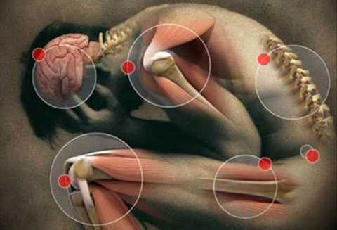 Fibromialgia y Síndrome de Fatiga Crónica Juvenil:  las más afectadas son las niñas y las adolescentes