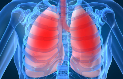 Síndrome de insuficiencia respiratoria aguda