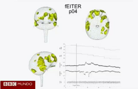 Captan por primera vez imágenes del cerebro al caer en la inconsciencia