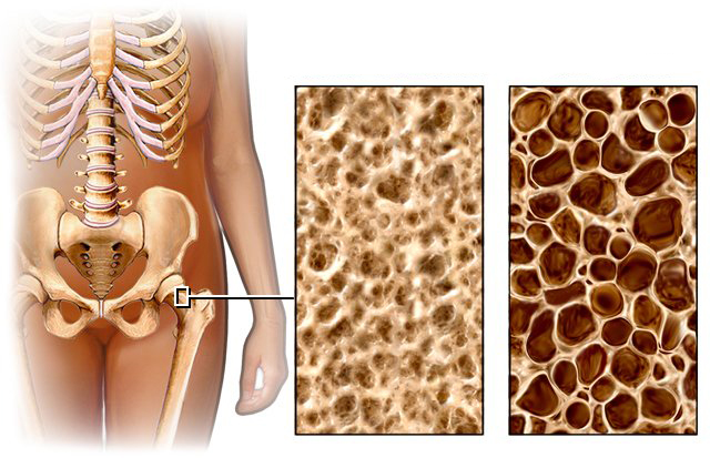 Osteoporosis