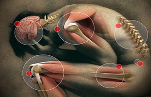 ¿Qué es el síndrome Guillain-Barré?