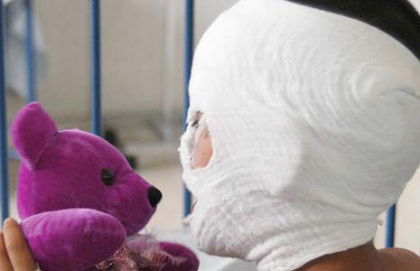 Colombia: mano dura para padres de niños quemados con pólvora