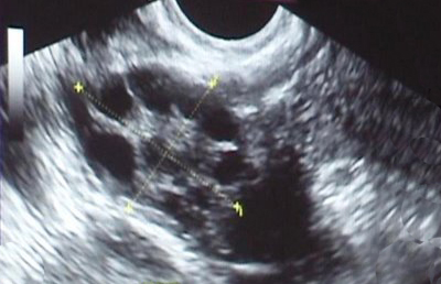 Ovario Poliquístico: un síndrome con consecuencias a largo plazo