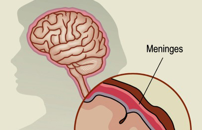 Meningitis