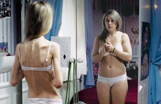 Anorexia: adolescentes bajo la lupa