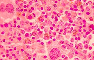 Mielofibrosis: una típica enfermedad poco frecuente