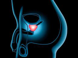 Logran retrasar progresión de cáncer de próstata