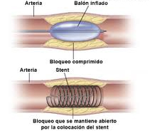 Cada vez más angioplastias para tratar enfermedad vascular