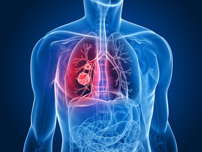 Baja adherencia al tratamiento de fibrosis quística