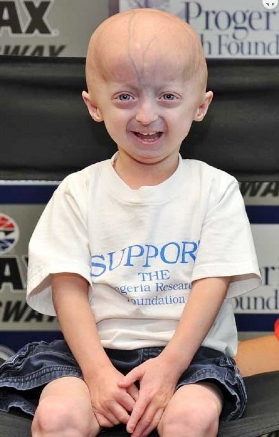 Expanden ensayos clínicos para reactivar la búsqueda mundial de niños con Progeria
