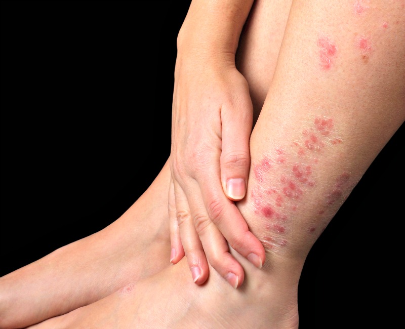 Consultas gratis para detectar casos de psoriasis