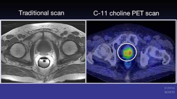 Hacen un mapa de la recaída del cáncer de próstata mediante exploración por PET y 11C-colina e imágenes de resonancia magnética