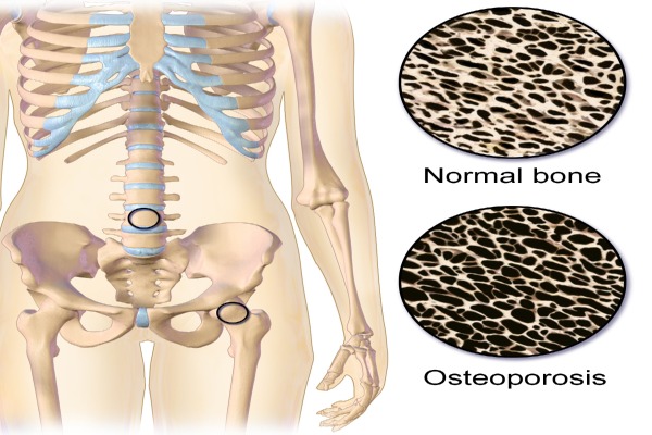Tres claves para prevenir fracturas, 20 de Octubre Día Mundial de la Osteoporosis