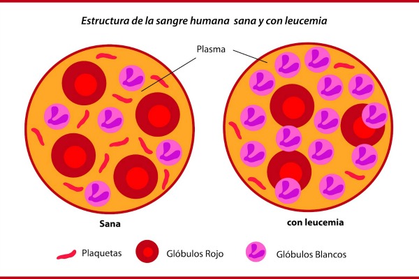 Crece el abordaje personalizado de la leucemia linfocítica crónica