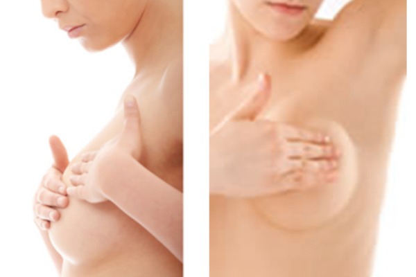 Claves para elegir el mejor implante mamario
