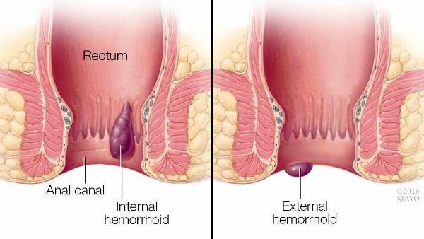 Autocuidados para aliviar las hemorroides