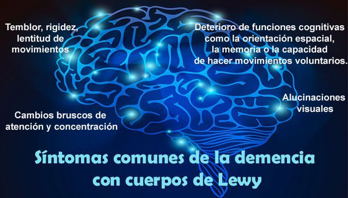 Ausencia de encogimiento cerebral puede predecir quién desarrolla demencia con cuerpos de Lewy