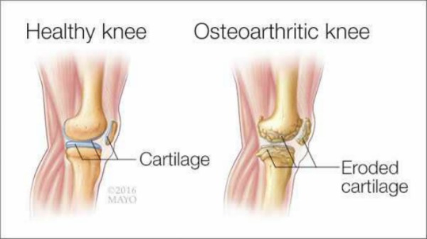 Tratamiento de la osteoartritis