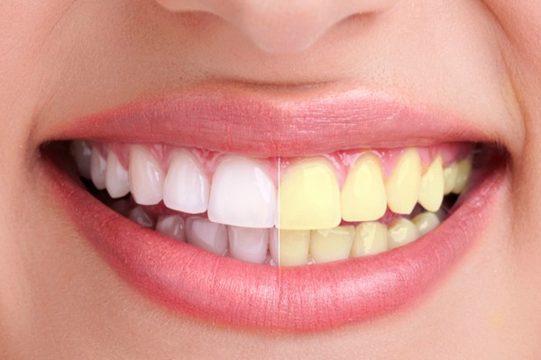 ¿Cuál es la manera más eficaz de blanquear los dientes?