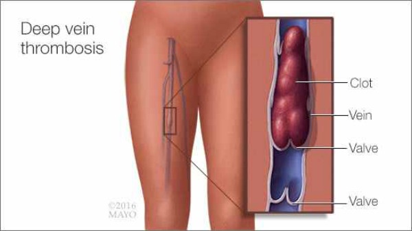 Trombosis venosa profunda y embarazo