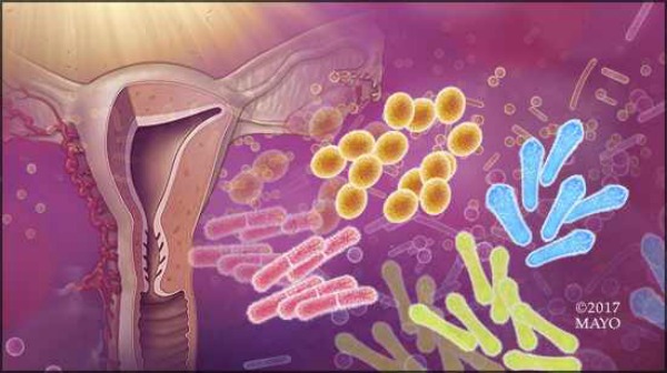 Microbios vaginales y cáncer de endometrio