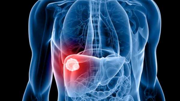 En 2030, el hígado graso causará más cáncer de hígado que la hepatitis