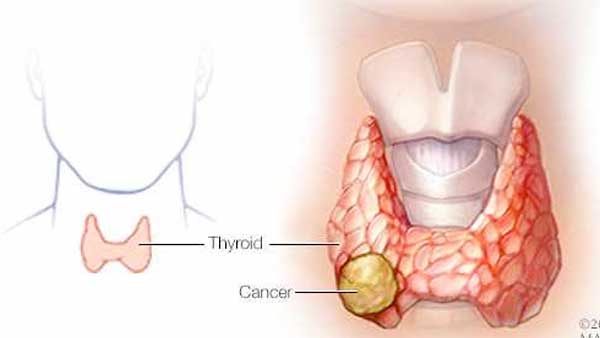 La mayoría de los casos de cáncer de tiroides son curables