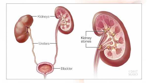 El tratamiento del cálculo renal se basa en su tamaño, tipo y ubicación