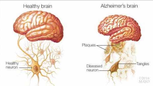 Identificar a la enfermedad de Alzheimer en las primeras etapas