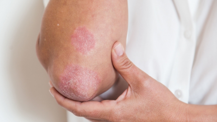 Psoriasis, la enfermedad del millón