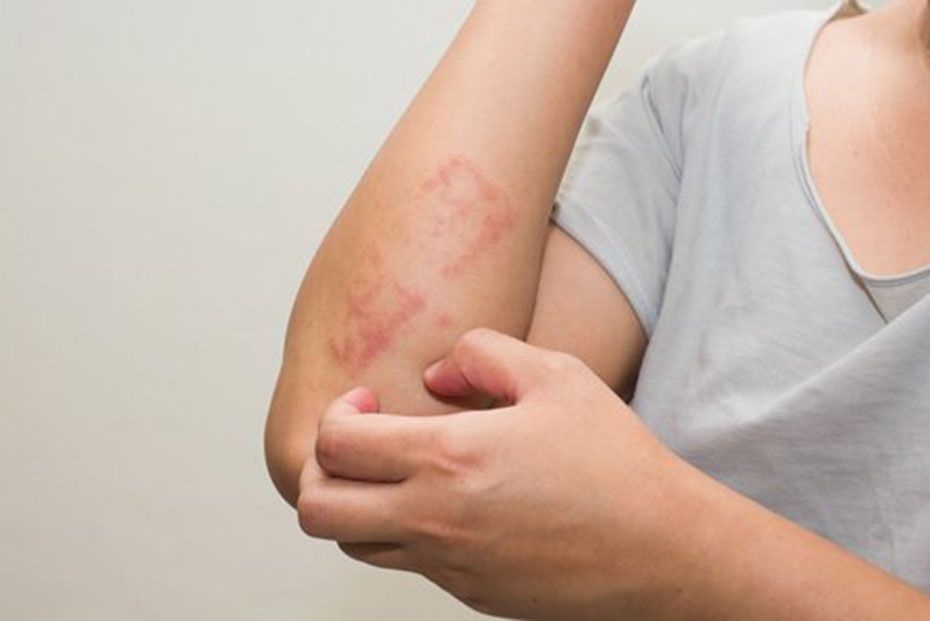 “La dermatitis atópica no es sólo un brote en la piel”