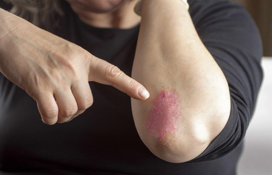 Campaña de detección gratuita y concientización sobre psoriasis