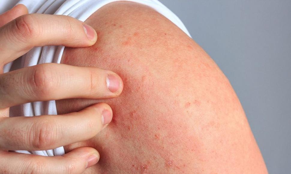 Los adolescentes con dermatitis atópica severa  pierden el 15% de los días de clase