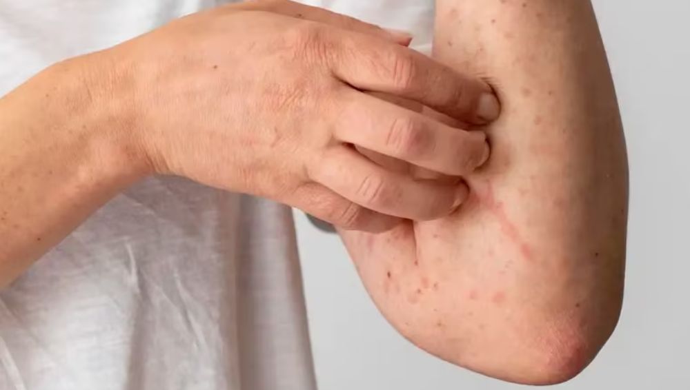 Nueva campaña para detectar dermatitis atópica