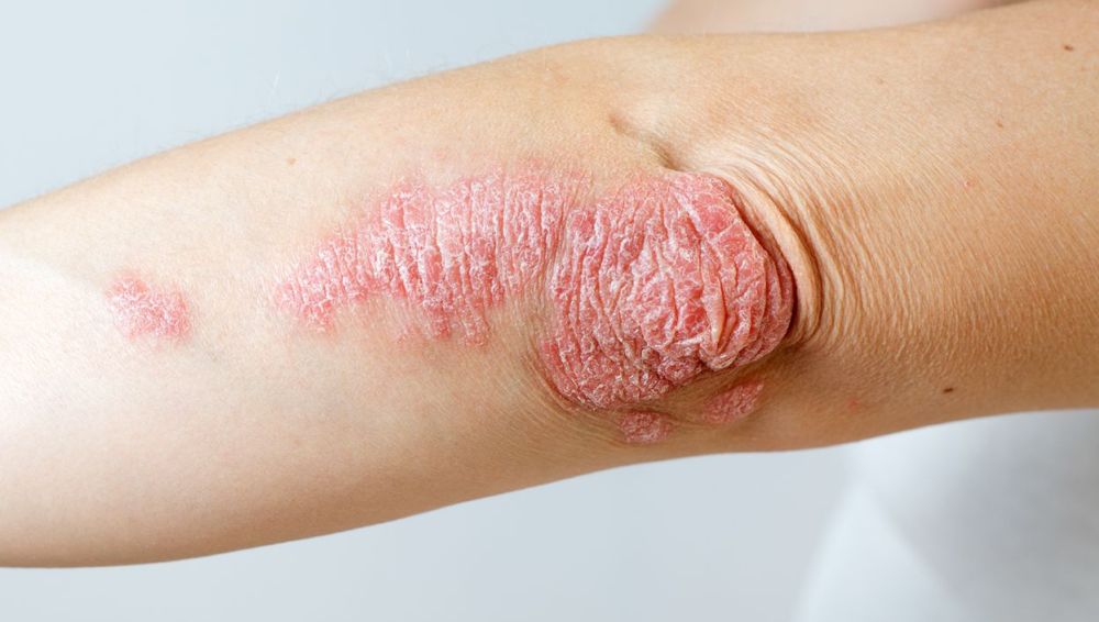 Campaña de detección y educación de psoriasis en el Hospital Pediátrico de Córdoba