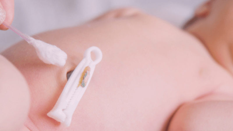 El cordón umbilical podría contener pistas sobre la salud futura de un niño