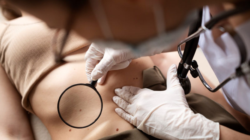 Nuevas tecnologías de detección de melanomas y las claves para protegerse del cáncer de piel