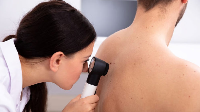 La IA aumenta los diagnósticos de cáncer de piel