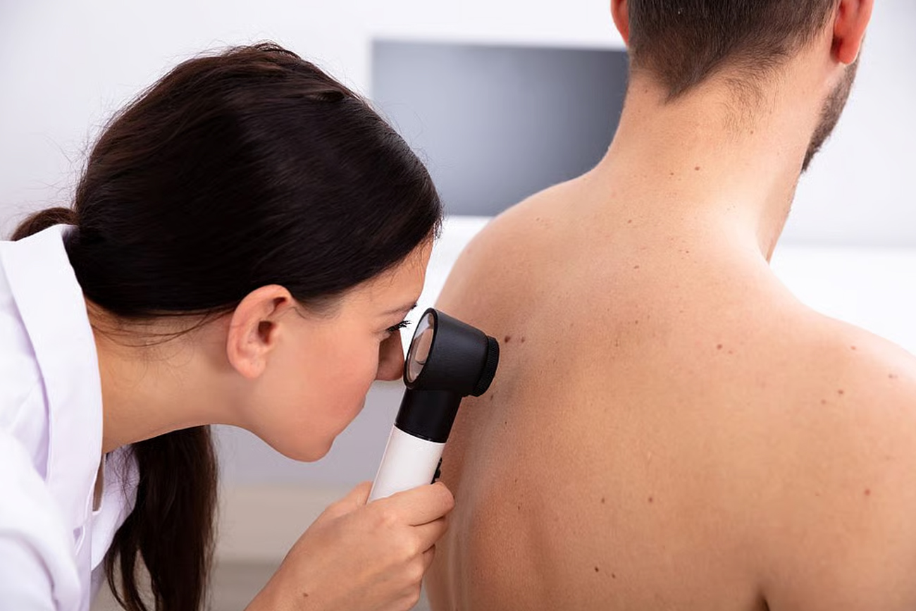 La IA aumenta los diagnósticos de cáncer de piel