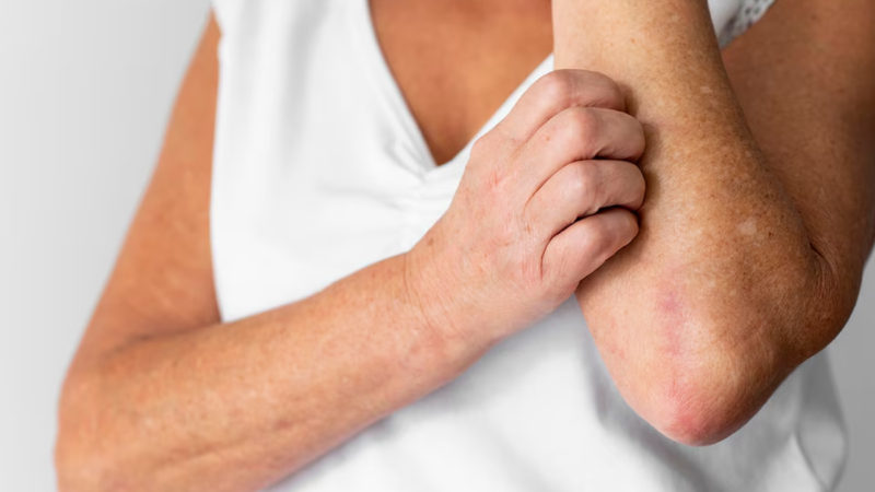 Campaña gratuita para la detección de psoriasis y artritis psoriásica