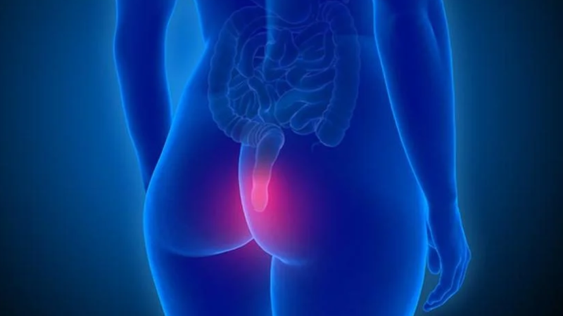 El sangrado rectal es el predictor más fuerte de cáncer de colon en menores de 50 años