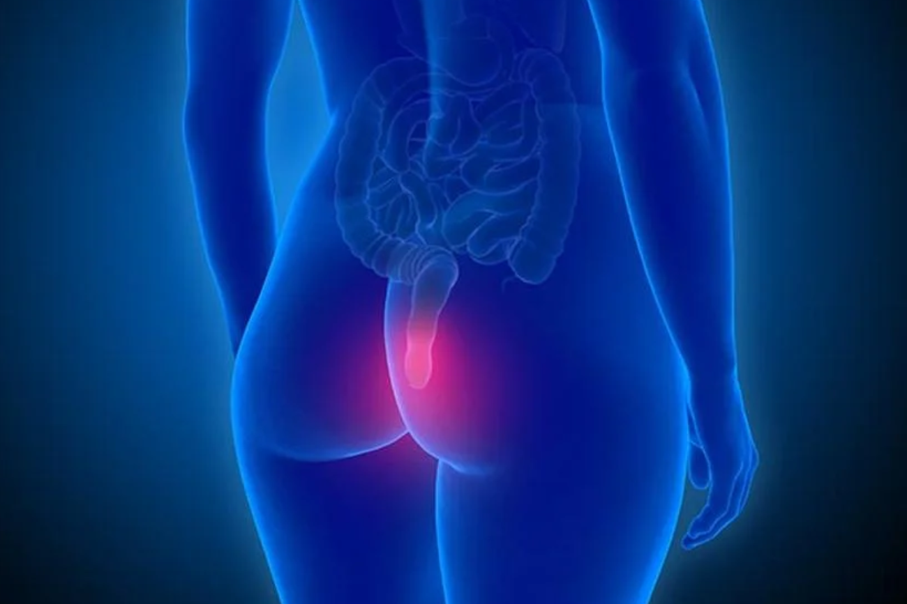El sangrado rectal es el predictor más fuerte de cáncer de colon en menores de 50 años