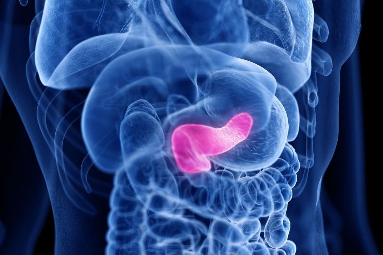 El índice de riesgo ayuda a predecir la recurrencia del cáncer de páncreas