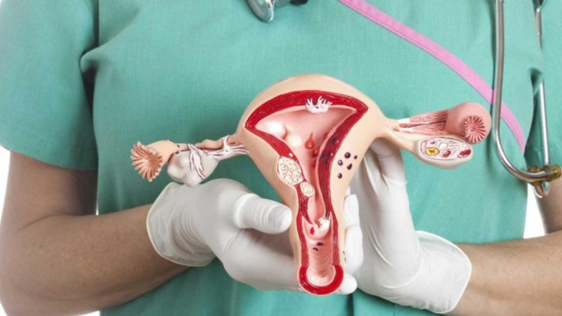 Cáncer de ovario: alertan por demoras en el diagnóstico que afectan el pronóstico