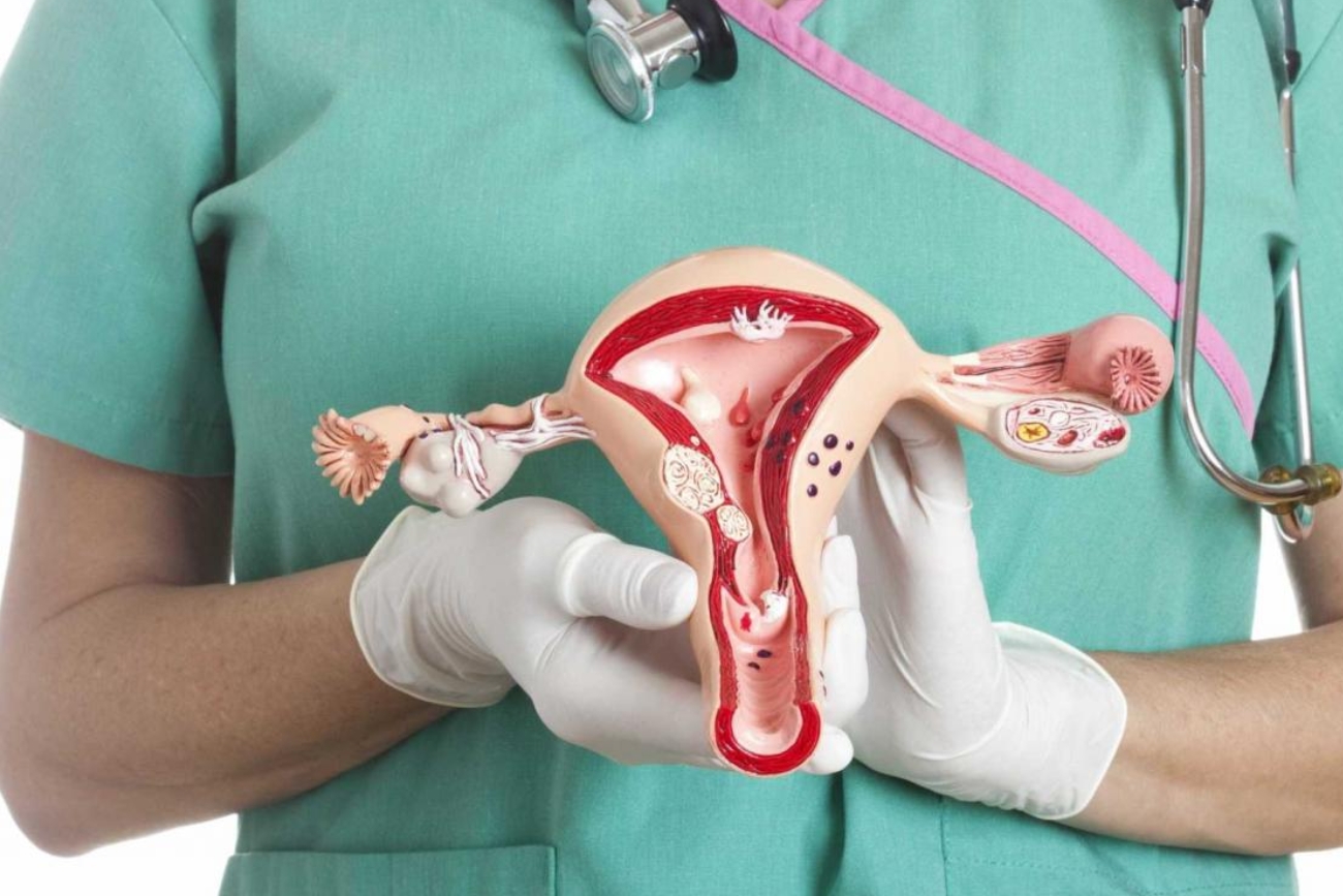 Cáncer de ovario: alertan por demoras en el diagnóstico que afectan el pronóstico