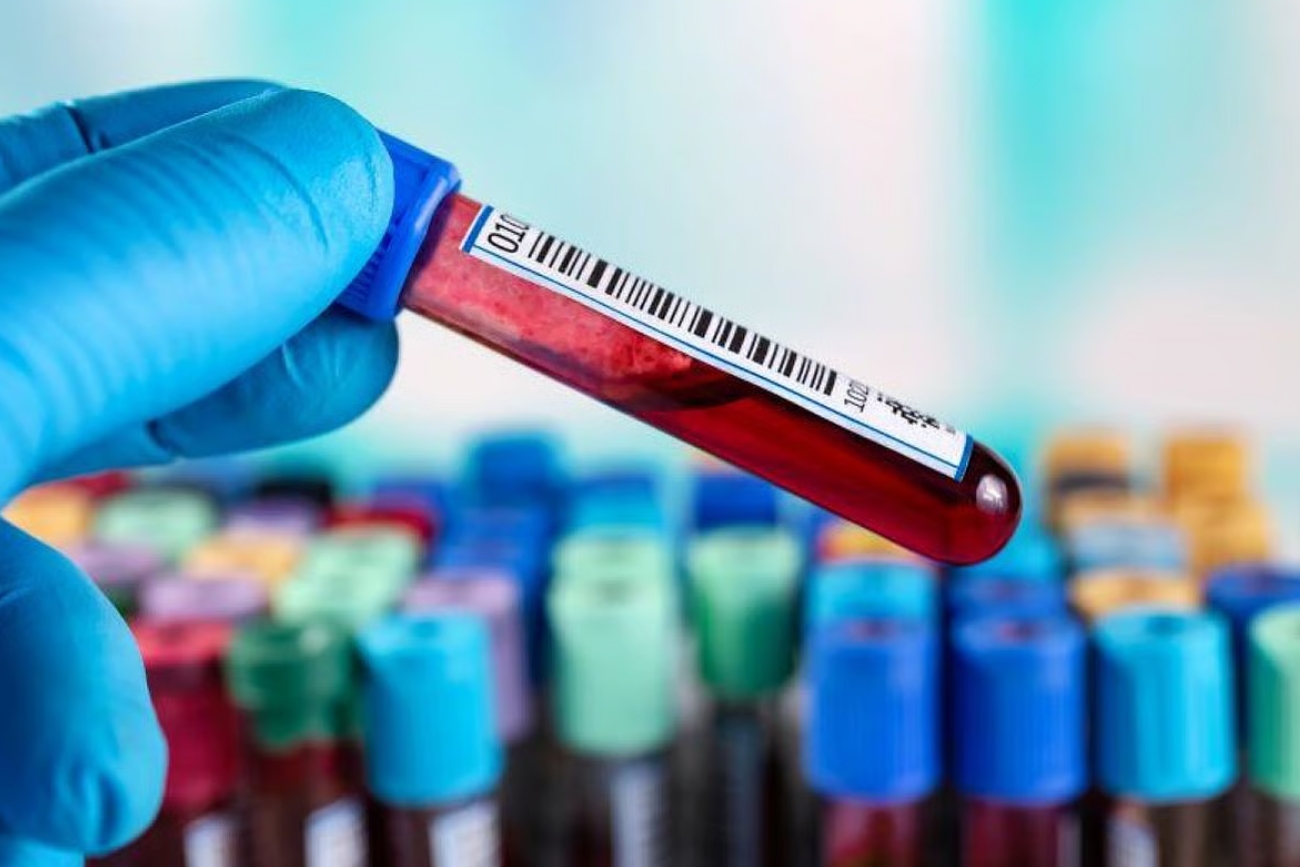 Un nuevo análisis de sangre mejora la detección de los cánceres de próstata más agresivos