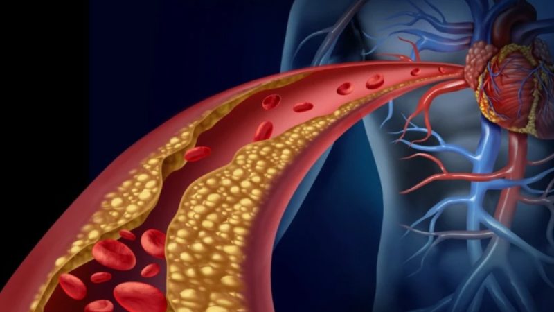 Colesterol bajo control: las nuevas guías impulsan tratamientos más personalizados para prevenir infartos y ACV