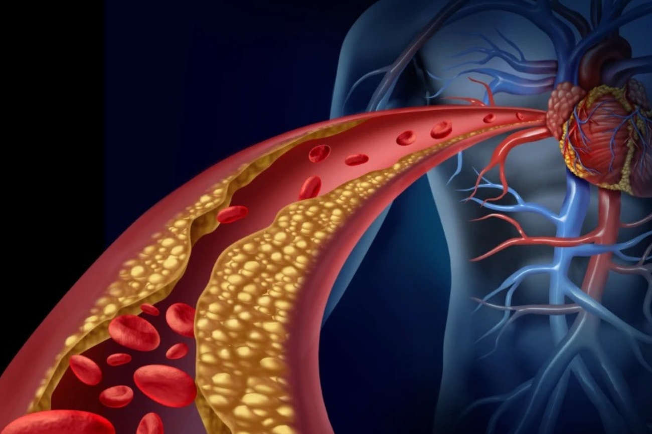 Colesterol bajo control: las nuevas guías impulsan tratamientos más personalizados para prevenir infartos y ACV