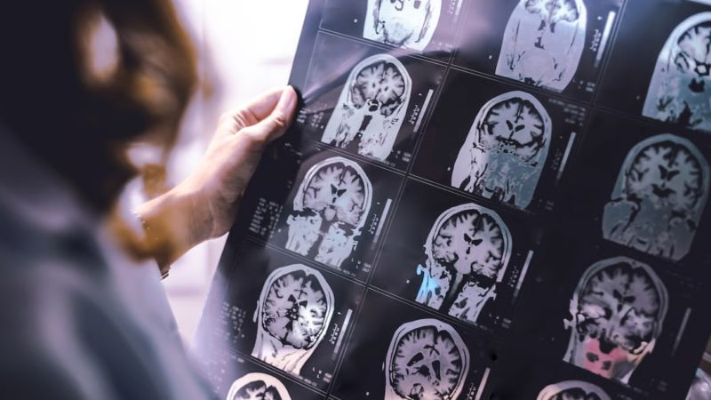 La inteligencia artificial revela lesiones cerebrales ocultas en pacientes con esclerosis múltiple