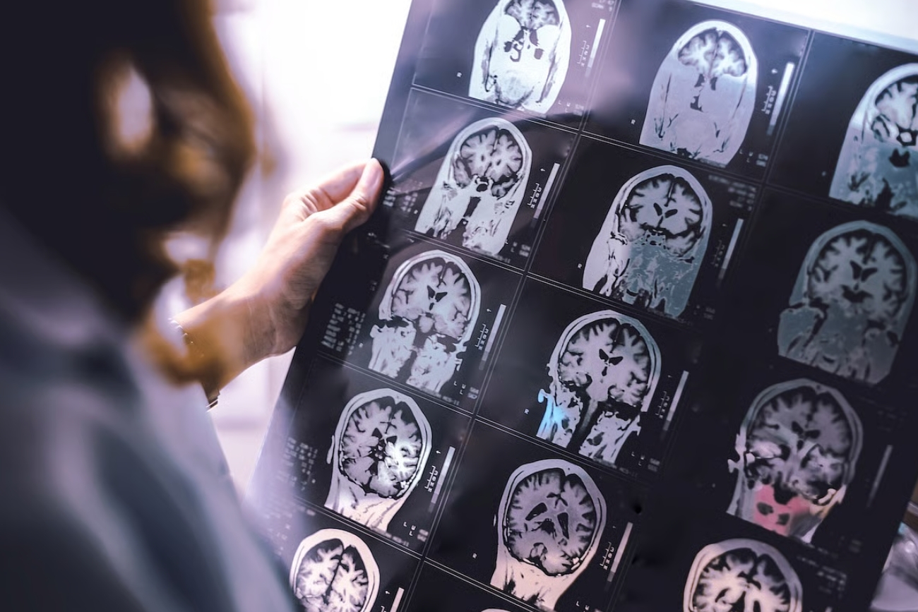 La inteligencia artificial revela lesiones cerebrales ocultas en pacientes con esclerosis múltiple